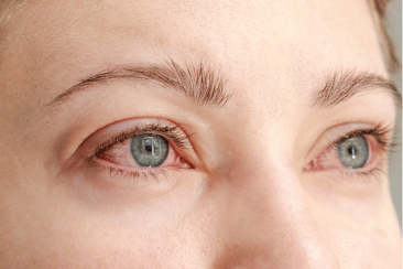 Wearing contacts while diving can cause damage to your eyes